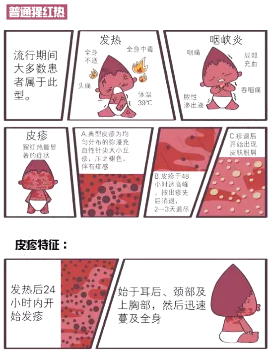 猩红热潜伏期 1~12 天,多为 2~5 天,主要特点是急性疾病,高热伴咽痛和